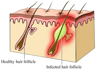 foliculita cauza